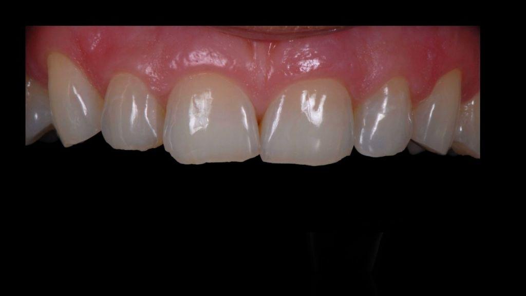 21 Img. 21 CASE 3 A 42 year old female with healthy gums had received orthodontic treatment and had the desire not only to have a lighter shade of teeth but wanted to have slightly longer teeth.