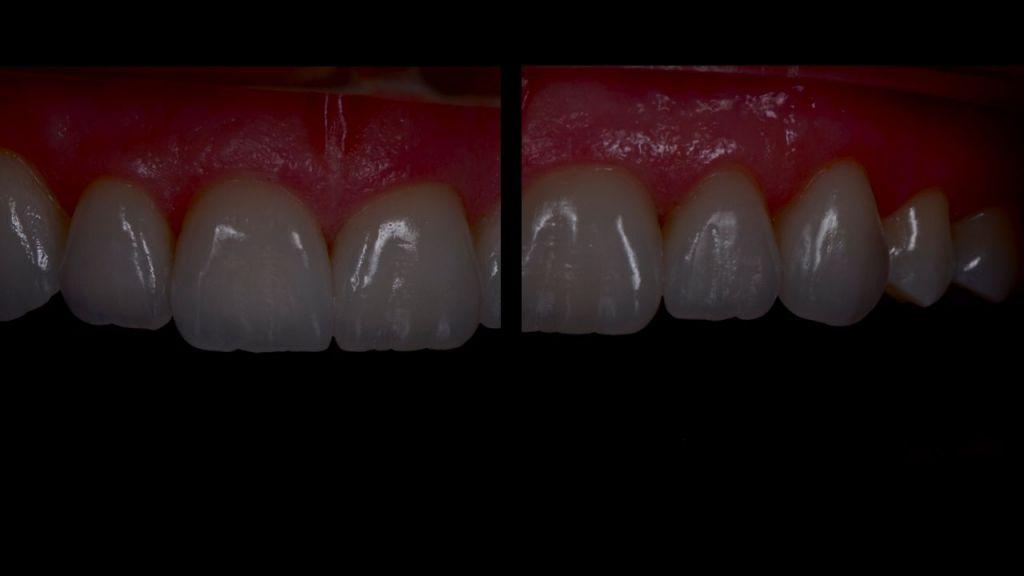 26 Img. 26 Occlusal view to show the precise fit of the veneers and also labial texture.