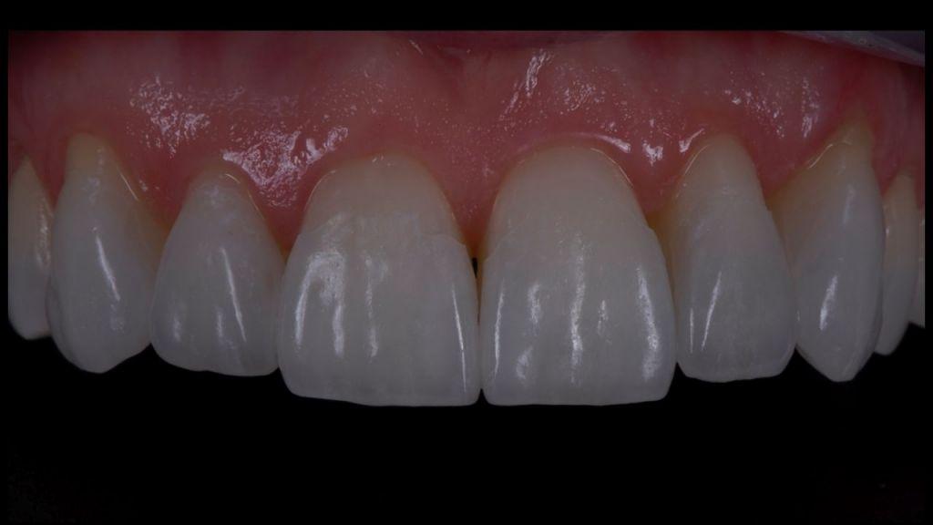6 Img. 6 Refractory Die Technique employed to fabricate feldspathic veneers. 7 Img. 7 Try in of No Prep veneers: one can note that the margins are not completely flush with the teeth.