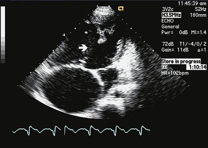 11. Color Doppler in the parasternal short axis view showing a turbulent jet immediately inferior to the tricuspid valve seen at approximately the 10 o clock position on the clock face of the aortic