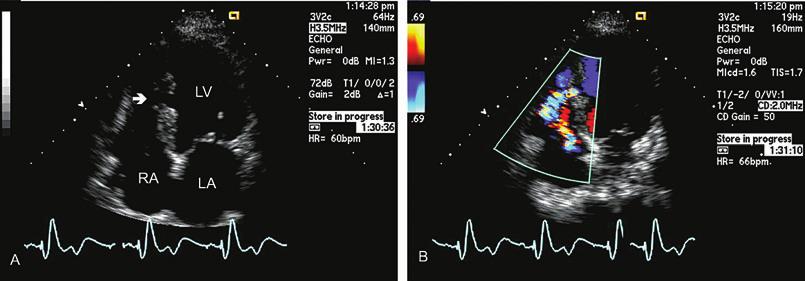 Supracristal VSDs are also best seen in the parasternal short axis view at the base of the heart and appear as a systolic color flow jet just beneath the pulmonic valve at the 2 o clock position on