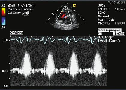 Color Doppler flow confirms the VSD (B). nary outflow obstruction, the pulmonary systolic pressure can be inferred from the right ventricular systolic pressure.