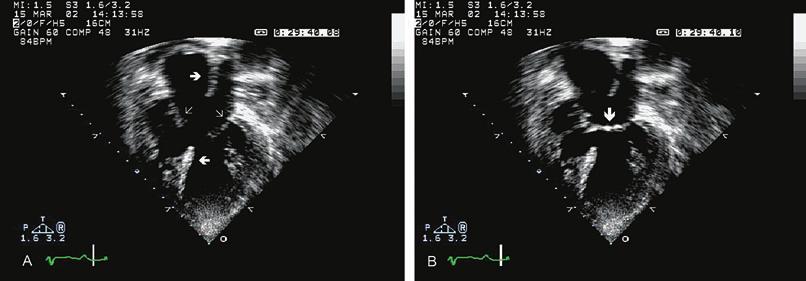 The peak gradient across the pulmonary artery band (B) is 20 mm Hg, suggesting that there is insufficient protection of the distal pulmonary vascular bed from increased pulmonary