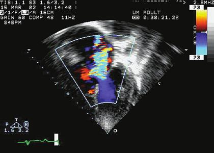 echocardiography in the adult with congenital heart disease 291 FIGURE 11.19. Color Doppler flow image of regurgitation of the AV valve in a patient with AV septal defect. opposite ventricle.