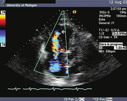 echocardiography in the adult with congenital heart disease 293 FIGURE 11.23. Color Doppler flow image of Ebstein s anomaly in the apical four-chamber view.