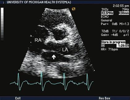 Obstruction to inflow of the left ventricle can take the form of cor triatriatum, mitral supravalvular ring, congenital mitral stenosis, or mitral atresia (usually as part of complex left ventricular