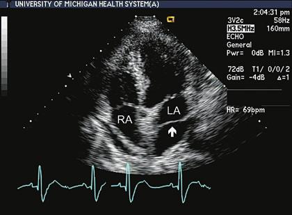 Cor triatriatum, caused embryologically by incomplete resorption of the floor of the common pulmonary vein as it merges with the roof of the left atrium, is characterized by the presence of a