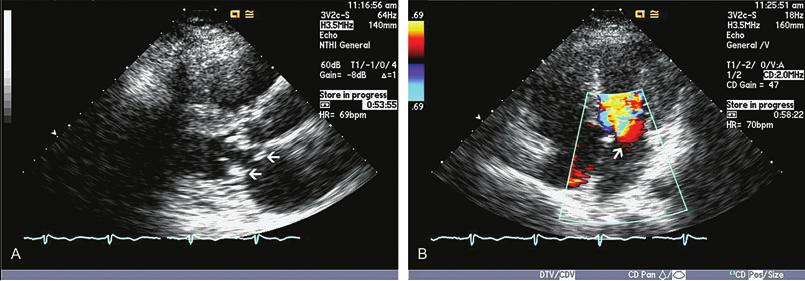 294 chapter 11 FIGURE 11.26. (A,B) A supravalvular mitral ring is noted just superior to the mitral valve at the mitral annulus in A (two arrows) in the parasternal long axis view.