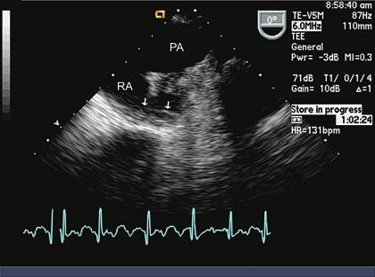 echocardiography in the adult with congenital heart disease 295 FIGURE 11.27.