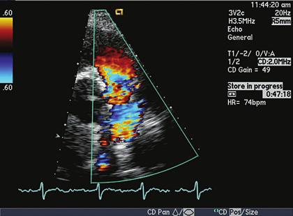 echocardiography in the adult with congenital heart disease 297 FIGURE 11.31. Color Doppler flow image of the pulmonary valve in the high parasternal short axis view.