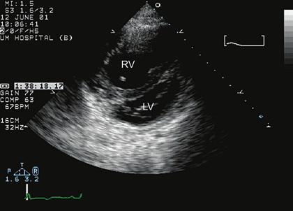 echocardiography in the adult with congenital heart disease 299 FIGURE 11.37. Parasternal short axis view of the ventricles in an adult with d-transposition of the great arteries.