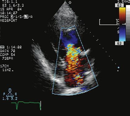 first successful operation was performed in 1975, which means that these patients are now entering their 30s and 40s and require continued echocardiographic monitoring for supravalvular aortic and