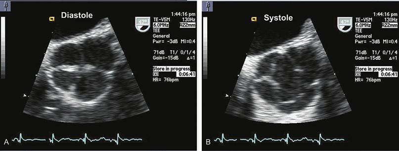 302 chapter 11 FIGURE 11.45. (A,B) A quadricuspid aortic valve is seen on a transesophageal echocardiogram short axis view in diastole (A) and systole (B).