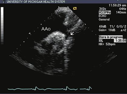 echocardiography in the adult with congenital heart disease 303 FIGURE 11.47. Suprasternal notch view in a patient with coarctation of the aorta.