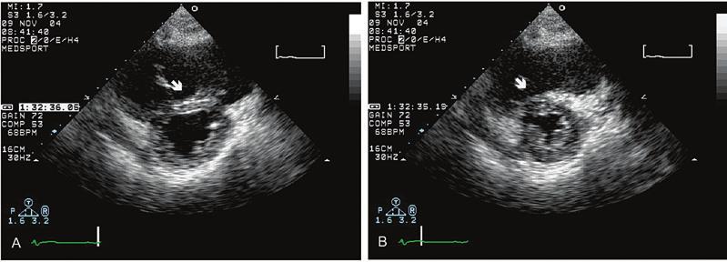 echocardiography in the adult with congenital heart disease 283 FIGURE 11