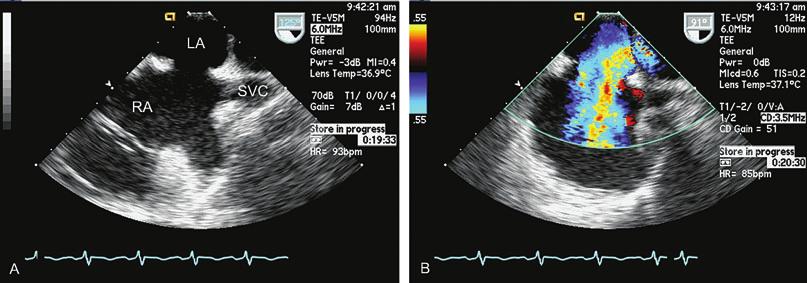 In diastole (A), right ventricular pressure equals left ventricular pressure, the interventricular septum is flat (arrow), and the left ventricle is D-shaped.