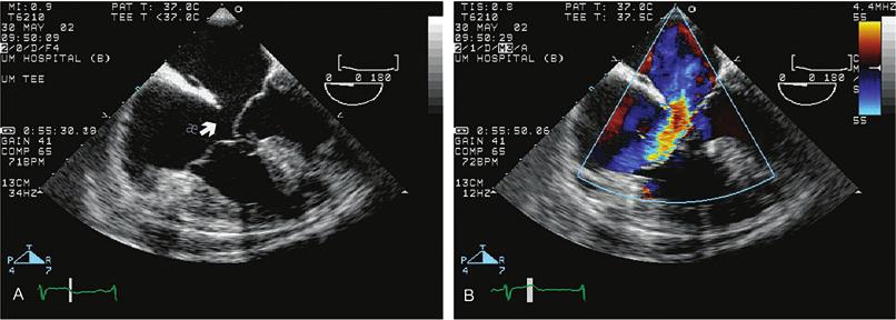 284 chapter 11 FIGURE 11.3. (A,B) Transesophageal echocardiogram of an ostium primum ASD.