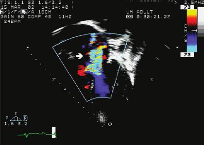 Shunting is primarily left-to-right on color Doppler with a zone of flow convergence seen on the left atrial side of the septum (B). to the beam of the ultrasound and ASDs may be viewed more directly.