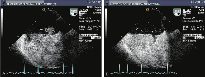 echocardiography in the adult with congenital heart disease 285 FIGURE 11.5. (A,B) Saline contrast injection in a patient with ostium secundum ASD.