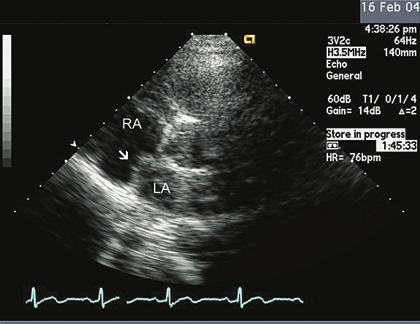 (B) A negative contrast effect is demonstrated when unopacified blood from the left atrium passes into the right atrium (arrow), creating an echocardiographic clear space. and characterization of ASD.