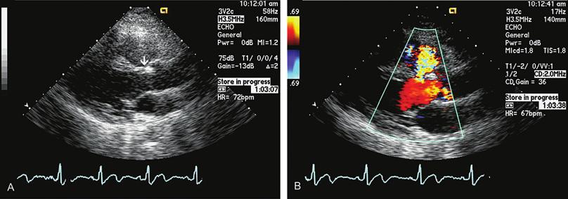 echocardiography in the adult with congenital heart disease 287 the septum and residual shunt on color Doppler flow mapping.