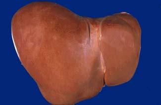 Common Liver Diseases Hemangioma