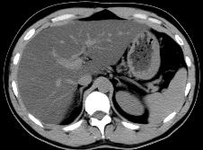 Diffuse Fatty Liver CT Attenuation