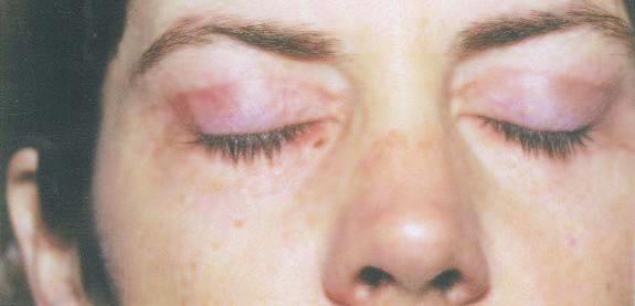 Figure 1. This 41-year-old woman is unhappy with color changes in her upper lid and complains that the scar is too high 3 months after upper eyelid blepharoplasty.