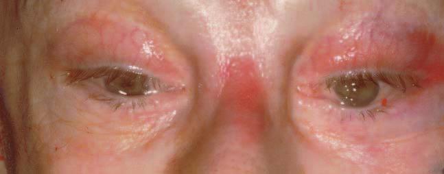 Figure 5. This 60-year-old woman underwent upper eyelid blepharoplasty 10 years ago. During an open coronal brow lift, significant lagophthalmus developed.