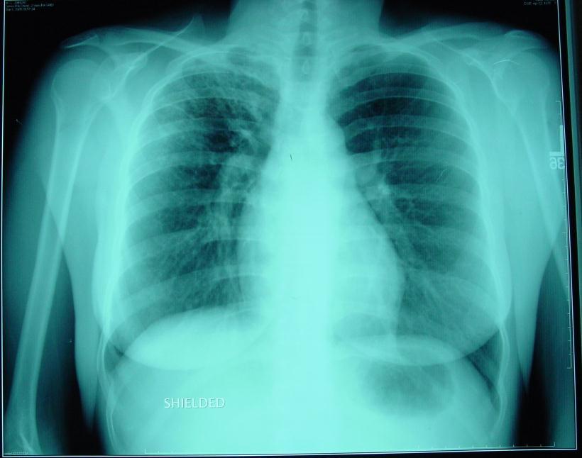 March 8, 2005: 30 yr old refugee from Uzbekistan Evaluation and Management of Refugee CXR in US: abnormalities in right apex, age and