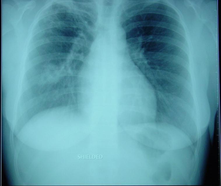 Evaluation and Management of Refugee Hemoptysis 6 months after arrival New abnormality on CXR History of dental abscess Diagnosed
