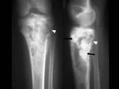 Osteosarcoma Clinical findings highly aggressive painful mass childhood and adolescents male Radiographic findings Usually mixed sclerosis and lytic (moth eaten or