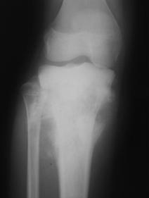 Codman triangle, perpendicular (sunburst or hairon end), lamination (rare) Extend across epiphyseal plate (75 90%) MR/CT for preoperative planning : NV,