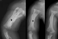 diagnosis: bone scan & MRI) Deep soft tissue