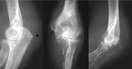 Osteomyelitis Spinal infection Findings mixed osteosclerosis & osteolysis