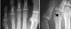 arthritis Clinical findings painful and swelling joint one joint, unilateral involvement Soft tissue swelling/joint effusion Periarticular osteopenia narrowing joint space Erosive arthritis
