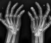 Radiologic finding (late stage) arthrosis and deformities secondary OA Subchondral cyst formation Subluxation Ulnar deviation of MCP Boutonierre and