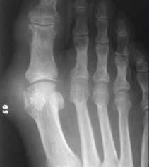 Osteoarthritis (OA) Clinical findings painful at weight bearing joints (knees and hip joints) several used joint (DIP joints of hands) bilateral