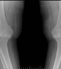 Osteoarthritis (OA) weight bearing or heavily used joints (knees, hips and hand=dip joints) bilateral involvement symmetrical involvement narrowing of