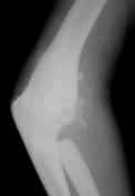 Charcot s joint Radiographic Fragmentation Soft tissue swelling Destruction of joint Sclerosis