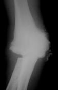 joint infectious is hematogenoue spreading Osteomyelitis Acute, subacute, chronic stage Joint disease