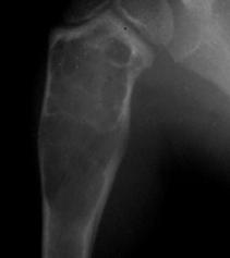 Location is a KEY Central proximal metaphyseal humerus (50%) proximal femur (20%) expansile, geographic bony