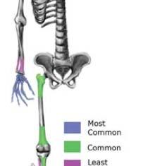 distal femur (20%) proximal tibia (17%) proximal humerus (17%) hand and feet (10%) Radiologic Findings geographic bony