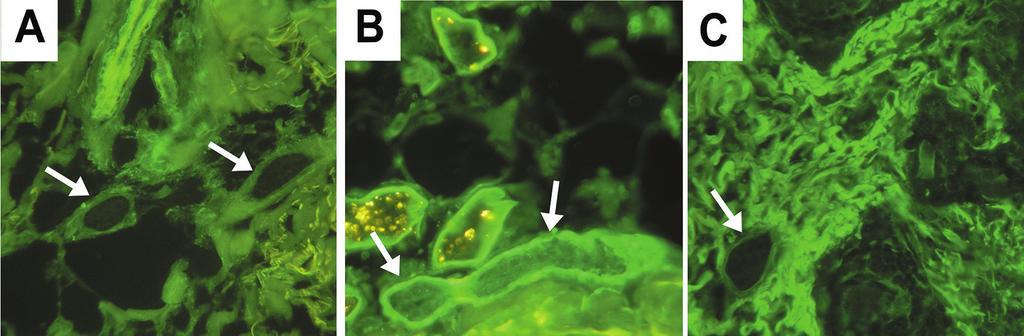 (B) Linear staining along the BM of intensity (arrow) and (arrow head) SGDs. (C) More prominent fluorescence of the BM of intensity SGDs (arrow) next to the sweat glands (asterisk).