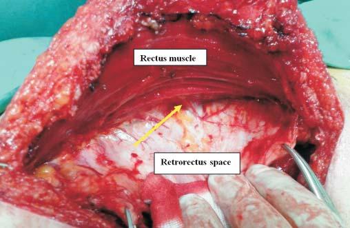 Transversus Abdominis Muscle Release (TAR) for Large Incisional Hernia Repair Chirurgia, 111 (6), 2016 537 prevent postoperative obstruction. Protect the viscera with a wide wet soft towel. 3.