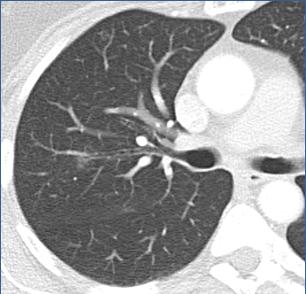 Differential diagnosis GGO Evaluation with CT