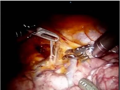 induction therapy 13 14 Robotic Lobectomy Robotic Lobectomy Oncologic results Multi institutional retrospective review (n=325) Majority