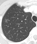 Case 2 59 year old woman investigated with CT chest for?