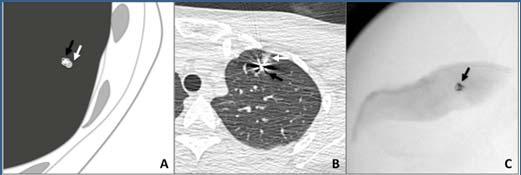 Localizing Techniques VATS Intraoperative imaging CT Thoracic ultrasound Preoperative CT guided marking