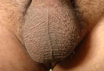 The Scrotum & Testes Prof. Dr. Imran Qureshi The Scrotum It is a cutaneous pouch of the anterior abdominal wall. Most layers of the abdominal wall are represented in its structure.
